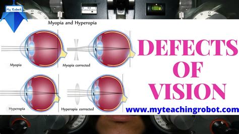 Eye Defects And Vision Youtube