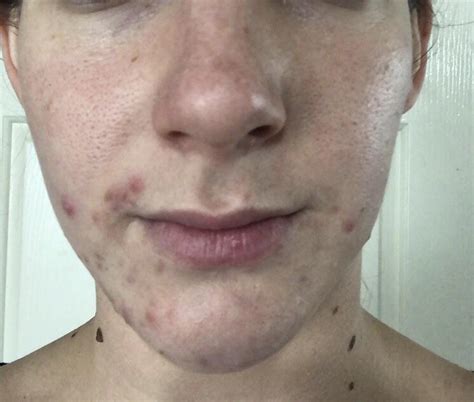 Skin Concern Started getting reoccurring acne clusters ...