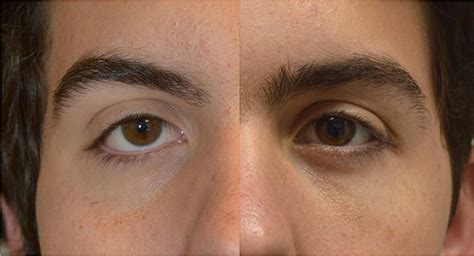Canthoplasty Surgery What Is It Dr Taban Beverly Hills