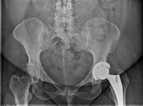 Robotic Surgery For Total Hip And Total And Partial Knee Arthroplasty