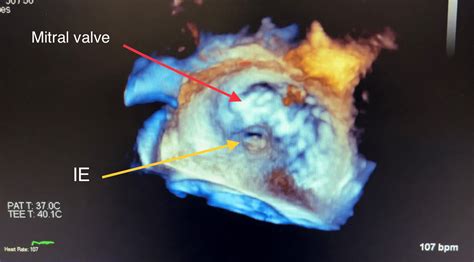 Cureus Aortic And Mitral Valve Infective Endocarditis Caused By
