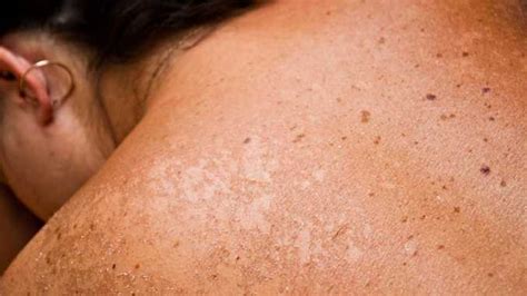 Sunburn Skin Cancer What You Should Know