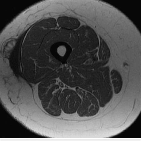 T2 Weighted Axial Mri Through The Right Thigh Showing A Simple