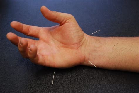Treatment For Carpal Tunnel Syndrome Philadelphia Acupuncture Clinic