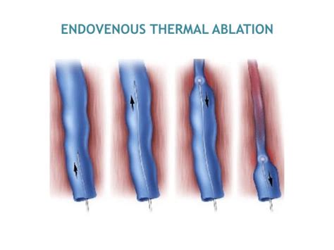 Vena Endovenous Thermal Ablation