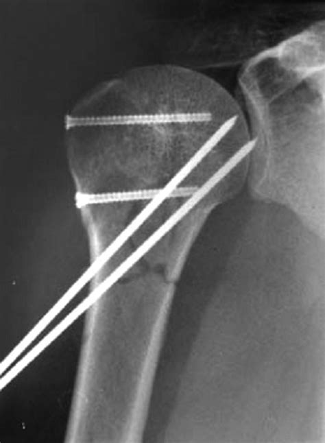 Proximal Humeral Fractures Bone And Joint