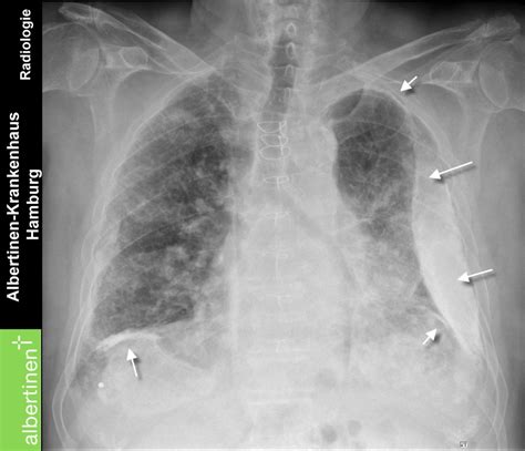 X Ray Of The Thorax Asbestos Plaques Doccheck