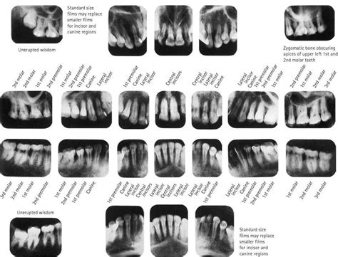 Dental Radiography Clarks Positioning In Radiography By A S Whitley