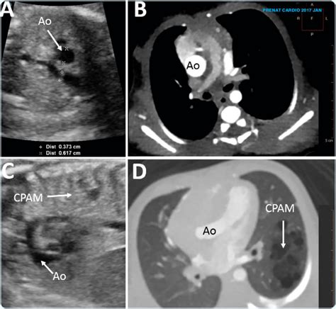 Dilatation Of The Ao A Prenatal Ultrasound Transverse View