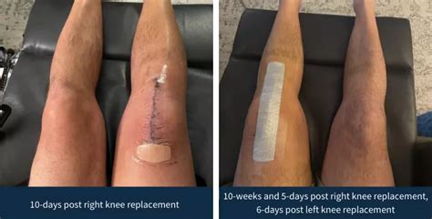 Double Robotic Knee Replacements And Remarkable Outcomes