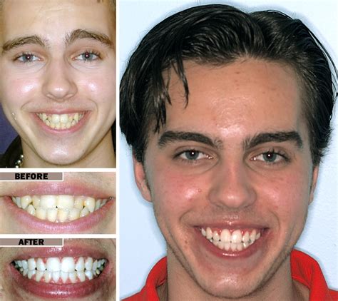 Traditional Clear Braces Photos