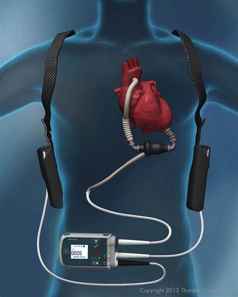 Heart Failure And Lvad Implant Management Deborah Heart And Lung Center