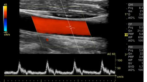 Arterial Sonography Of The Upper And Lower Extremities Sonographic