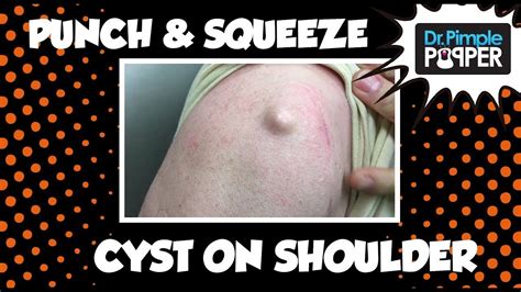 Epidermoid Cyst On The Shoulder Excised The Size Of A Marble Youtube