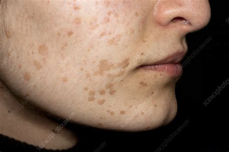 Flat Warts On The Face Stock Image C0110354 Science Photo Library