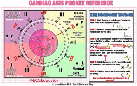 Usually accompanied by tall r wave in v1. ECG Educator Blog : Cardiac Axis Made Easy