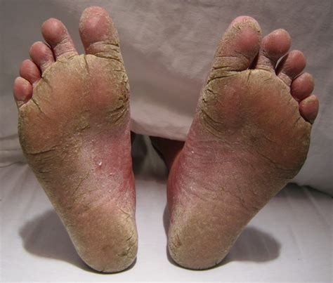 What Is Fungal Infection Mycosis