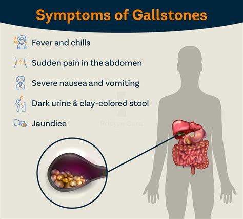 Gall Bladder Stone Symptoms