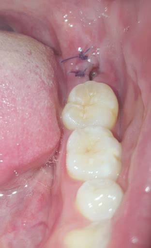 Impacted Wisdom Tooth Extraction Infection With Lock Jaw