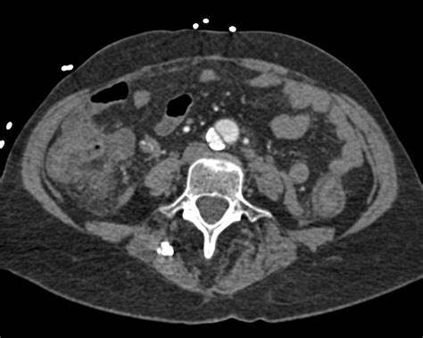 Dissection Of The Abdominal Aorta Chest Case Studies Ctisus Ct Scanning
