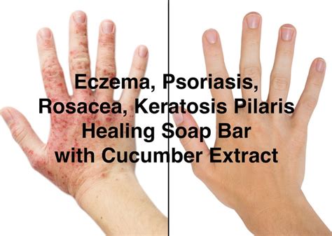 Eczema Psoriasis Rosacea Keratosis Pilaris All Natural Etsy
