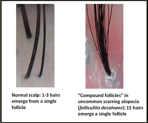 Multiple Hairs In One Follicle