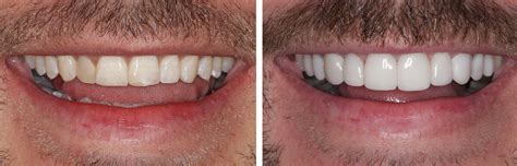 Dental Veneers Perfect Your Smile Today Avoca Beach Dental Clinic