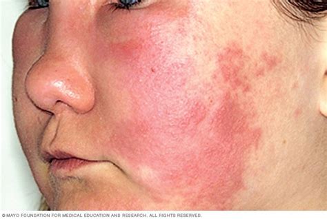 Hives And Angioedema Disease Reference Guide
