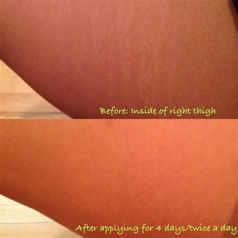 most stretchmark creams out there only treat dark red stretch marks or help prevent them if