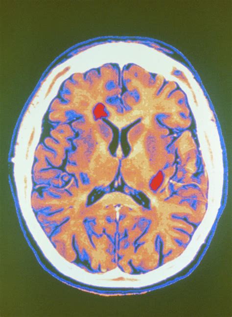 Coloured Mri Scan Of Brain In Multiple Sclerosis Photograph By Gca