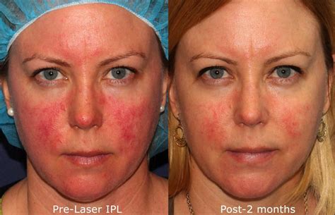 Ipl Photofacial San Diego Ca Cosmetic Laser Dermatology