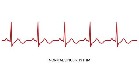 Ecg Heartbeat Line Electrocardiogram Vector Illustration Normal Sinus