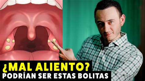 Bolitas Blancas En La Garganta Mal Aliento Causa Y Solución