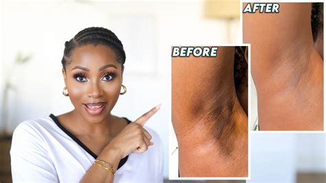 How I Got Rid Of My Dark Underarms How To Brighten Your Armpits Keep Them Even Smooth