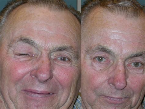 Left Side Of The Picture Patient With Hemifacial Spasm On The Right