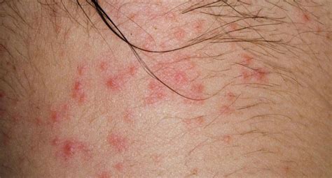 Skin Rashes That Itch Pin On Dermatitis Necrotizing Fasciitis Is A