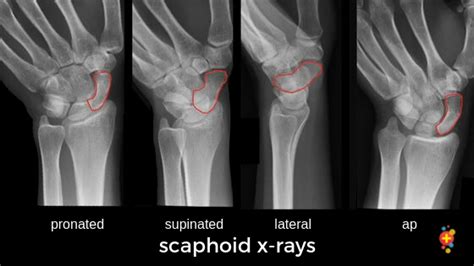 Scaphoid Fractures Dont Forget The Bubbles