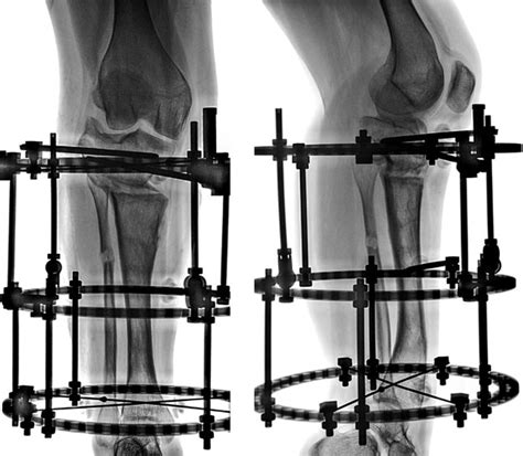 Ap And Lat Radiographs Of The Right Tibia During Consolidation Period