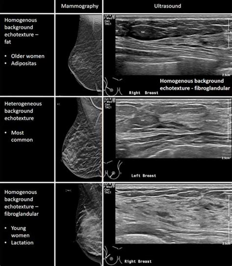 Basics Of Breast Ultrasound Radiology Ucla Health