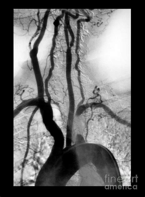 Aortic Arch Angiogram Photograph By Medical Body Scans Pixels