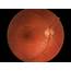 Optometry Case Study Optic Neuritis  Spectrum ANZ