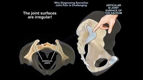 Sacroiliac Joint Pain Diagnosis Orthopaedicprinciples Com