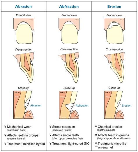 3d analysis by means of the finite element method text. Abrasion - Abfraction - Erosion. ANGRY... - Howard Farran ...