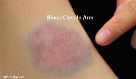 Blood Clot In Arm Symptoms Causes Diagnosis Treatment