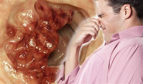 If you go to your doctor when you first notice symptoms, your cancer might be diagnosed earlier, when treatment is most likely to be helpful. Bowel cancer: Experiencing more gas is an early symptom of ...