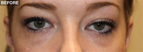 Ptosis Treatment For Congenital Ptosis Drooping Eyelids Surgery