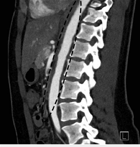 Sagittal Ct Angiogram Of The Abdomen Showing An Undulating Appearance