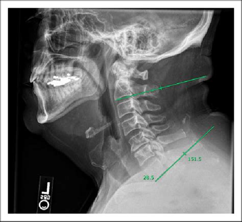 C2 7 Cobb Angle Lateral Cervical Radiograph Demonstrating The