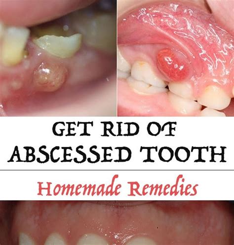 How To Get Rid Of Abscessed Tooth Top Beauty Enhancer