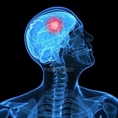 Visual Render Of Brain Cancer — Oncology Human Physiology Stock